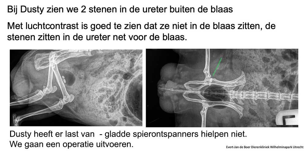 Er zijn twee stenen te zien die buiten de blaas liggen